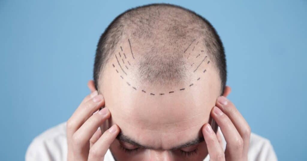 Why Affordable Hair Transplant FUT is the Best Option 