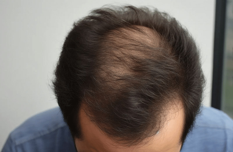 Natural looking hair growth after FUE hair transplant surgery