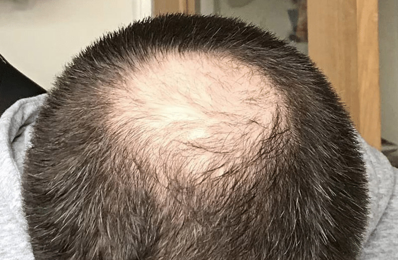 Can having an FUE Hair Transplant leave scars?