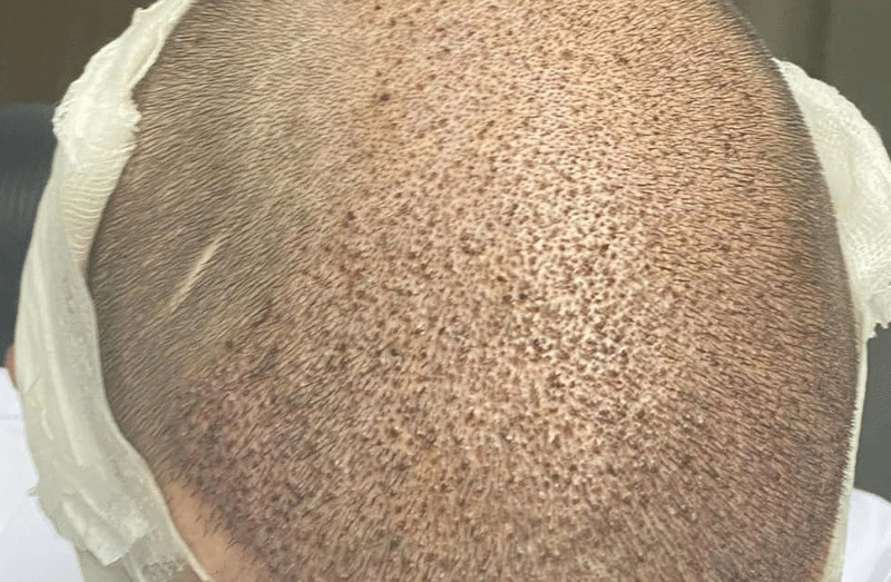 Hair transplants on scar tissue are possible