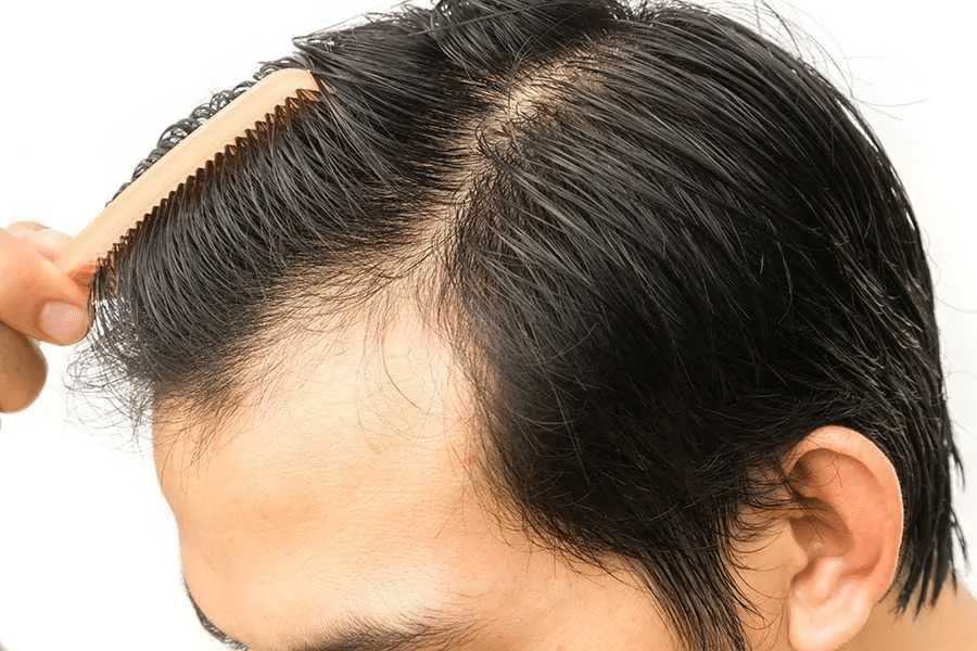Are you a candidate for a Follicular Unit Extraction FUE procedure?