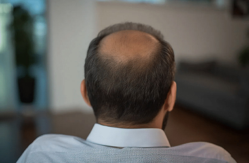 Surrounding hair still in tact with visible bald spot before hair transplant surgery