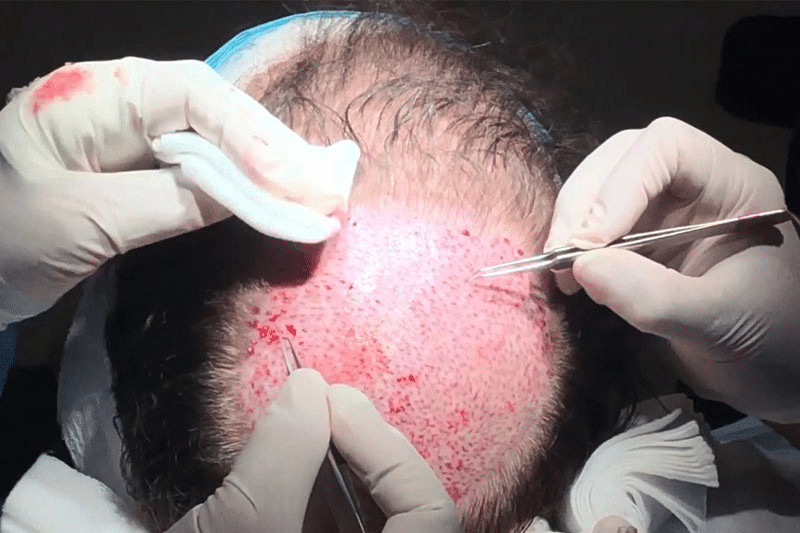 Follicular Unit Extraction hair follicles implantation procedure
