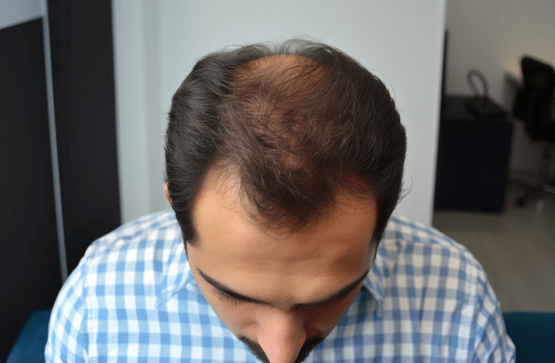 Results you might expect months after hair transplant surgery