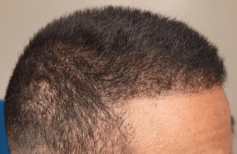 Los Angeles FUE hair transplant patient after light hair growth