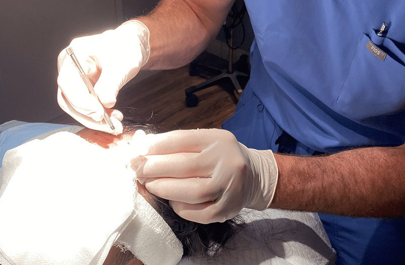 Extensive FUE hair restoration may take an entire day (8 hours) to complete.