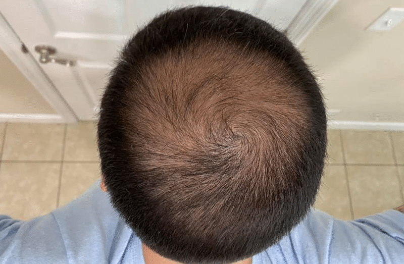 A skilled hair transplant doctor can help you achieve amazing results with LA FUE hair restoration