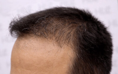 What Will My Hair Transplant Look Like After FUE 3 Months Post Surgery?