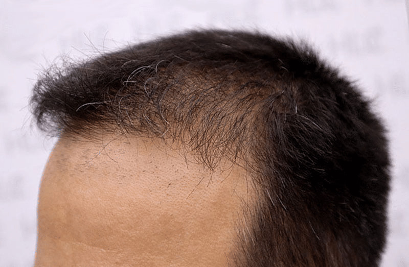 What Will My Hair Transplant Look Like After FUE 3 Months Post Surgery?
