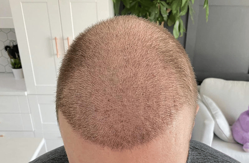 Newly transplanted hairs beginning to grow but expect potential shock loss