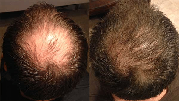 You may benefit from single-day mega session FUE hair transpalnts