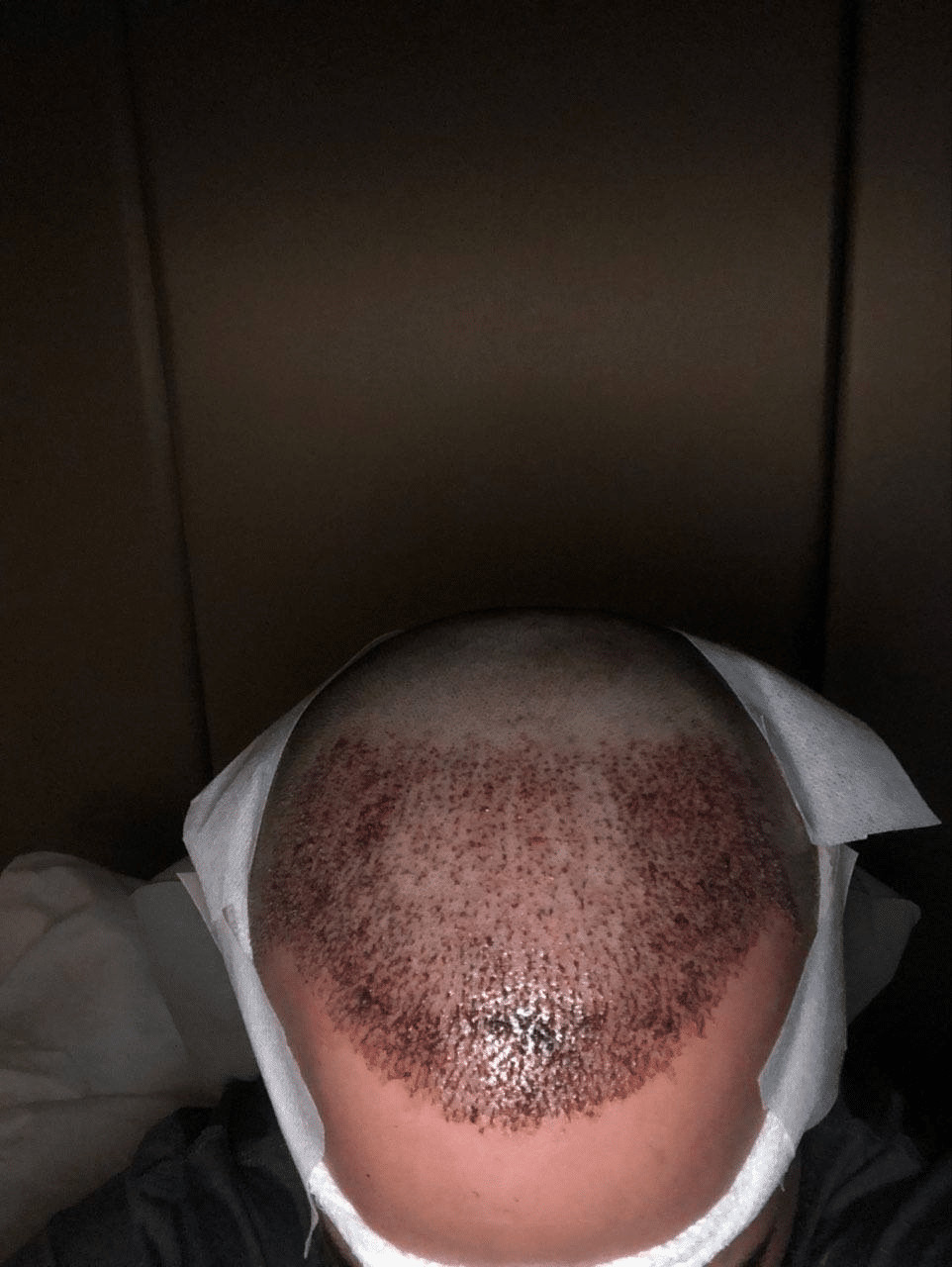 Red dots and mild red irritation after a Follicular Unit hair follicle donor surgery