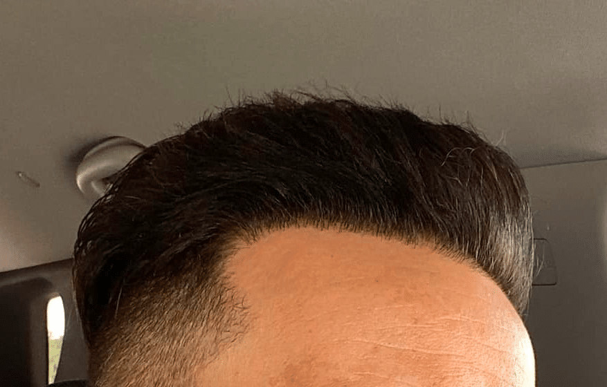 Best Hair Transplant offer the most affordable FUE hair transplant operations in LA