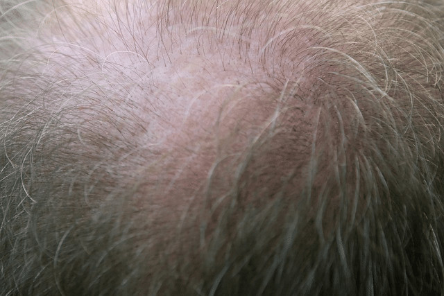There are many treatment options for balding for men and women