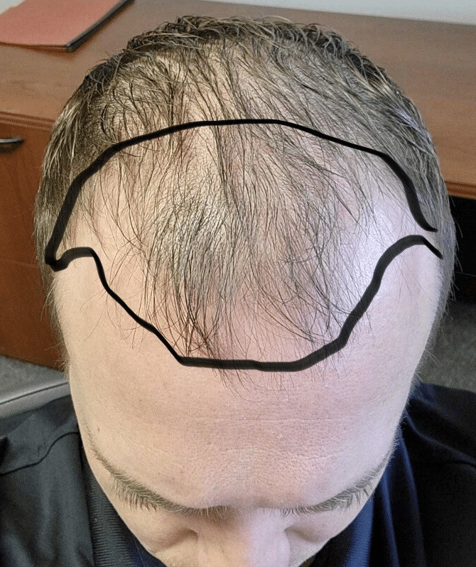 A patient in need of a hair transplant