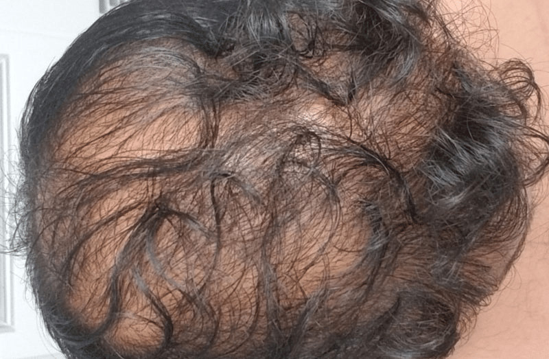 What causes diffuse hair loss?