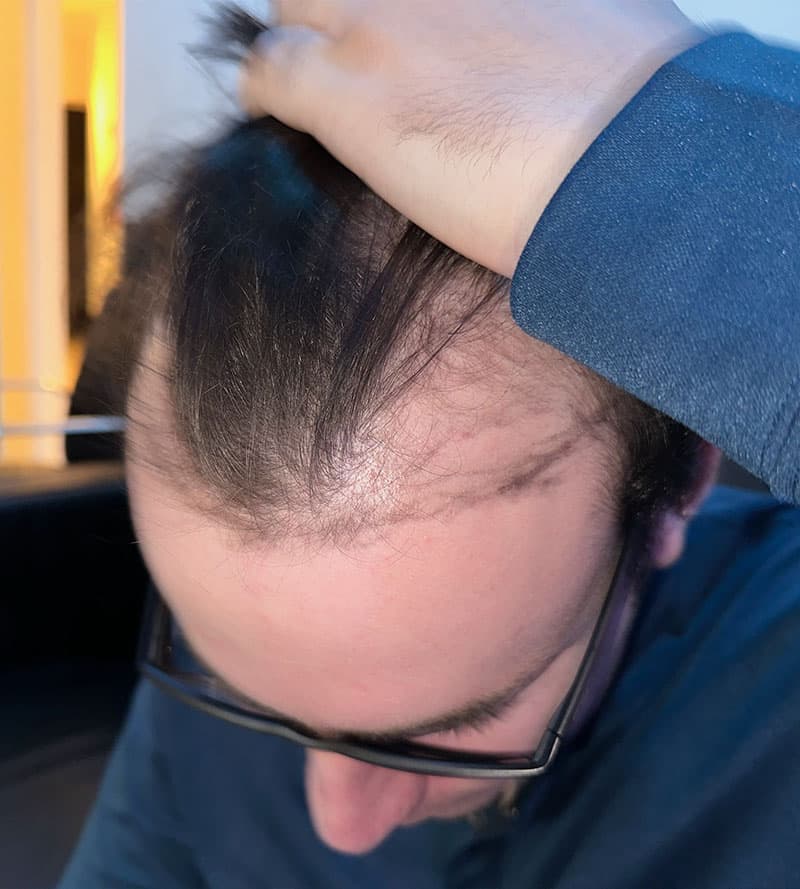 Male patient before FUE hair transplant