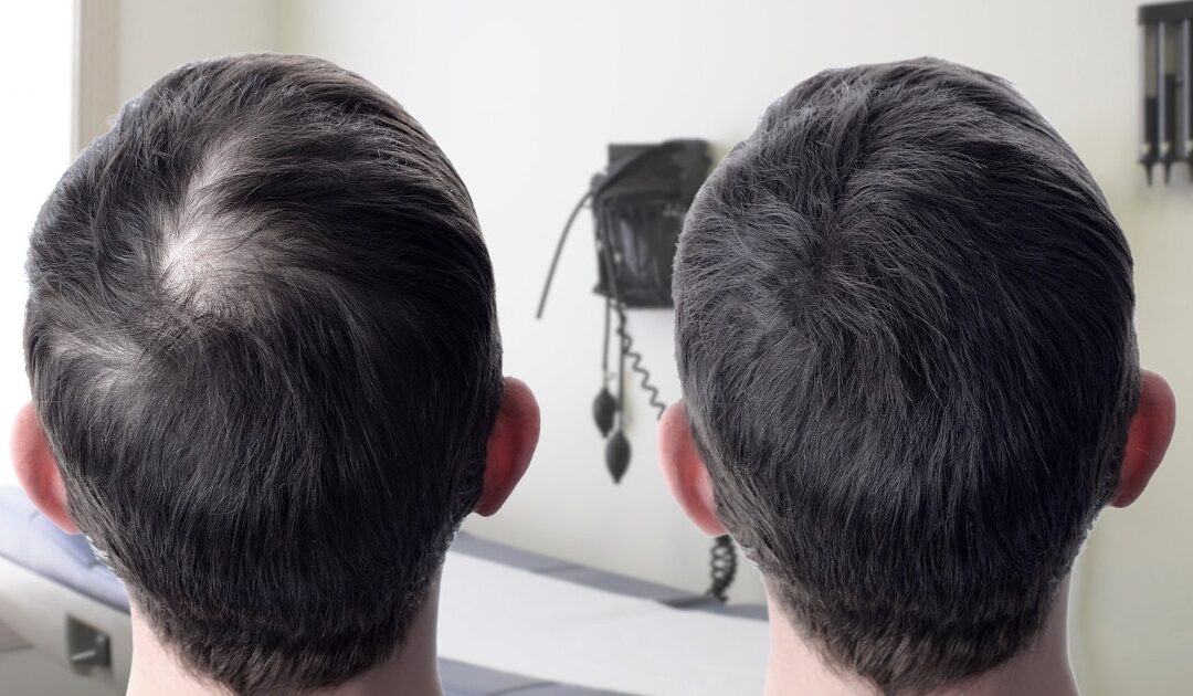 Is An FUE Hair Transplant Right For You?