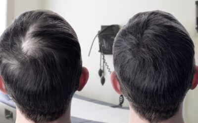 Is An FUE Hair Transplant Right For You?