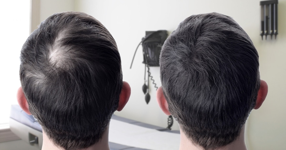 Follicular Unit Extraction Vs ARTAS, Hair Restoration Before & After