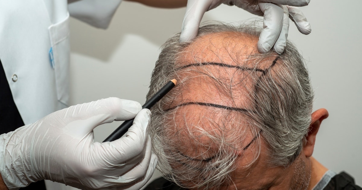 FUE Hair Transplants, Fue Grafts, Hair transplant Surgery Consultation