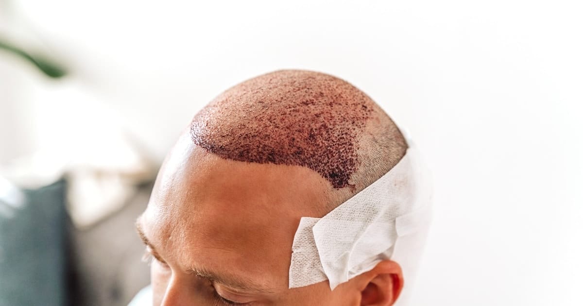 FUE Hair Transplant Post-Procedure