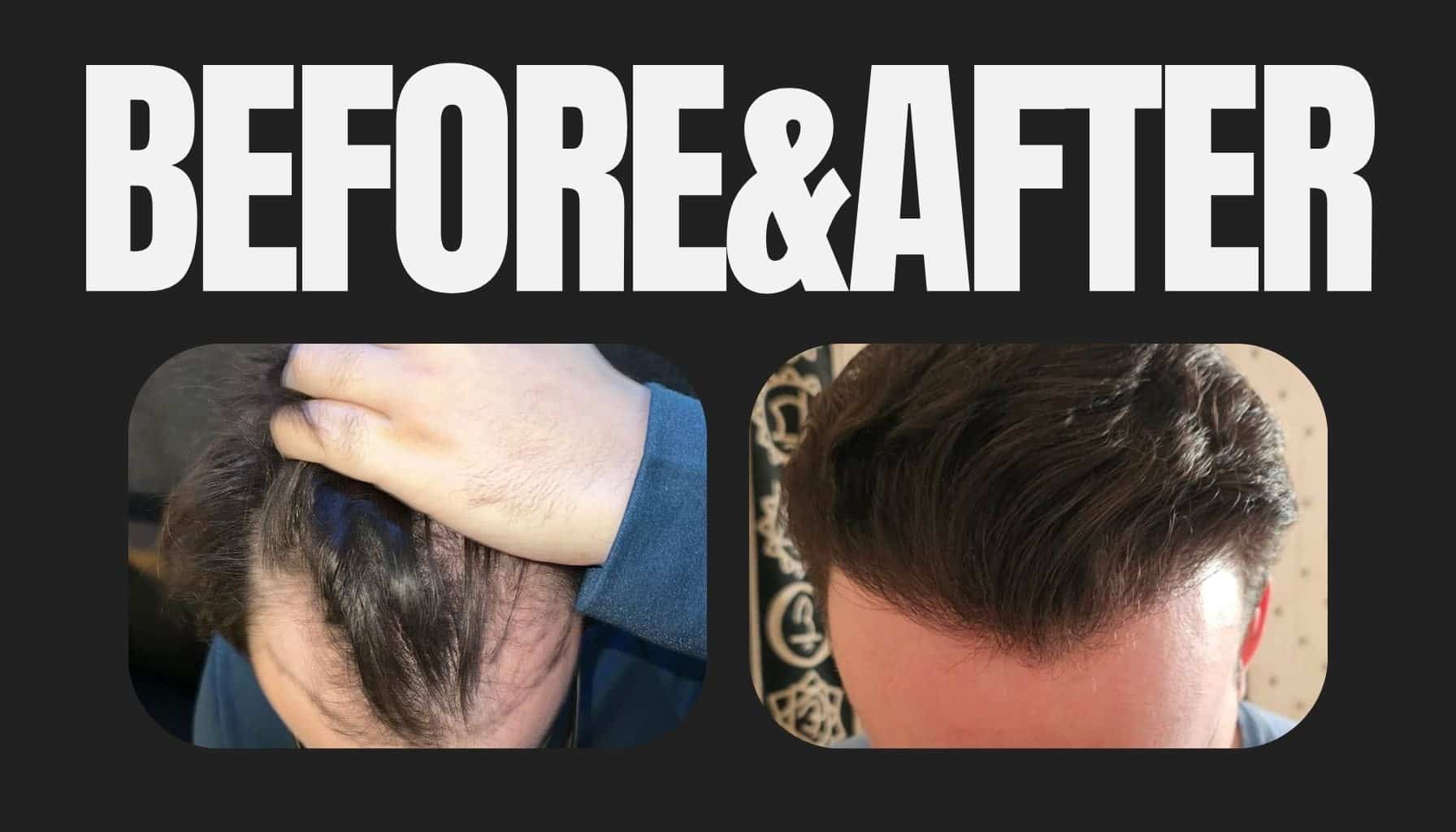 before-and-after photos of patients who have had successful hair transplants.