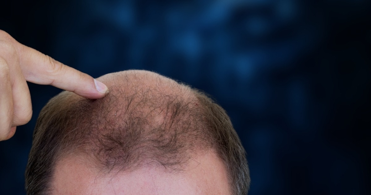 Hair Transplant Post Operation, Shock Loss, Shedding Hair