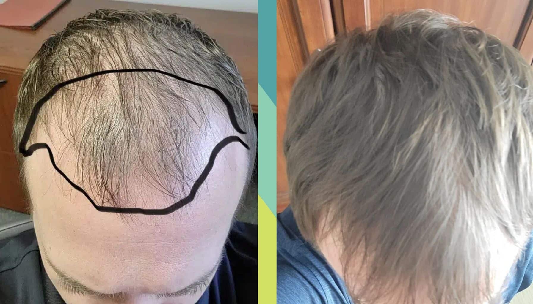 Before and after photos of a patient who underwent FUE hair transplant.