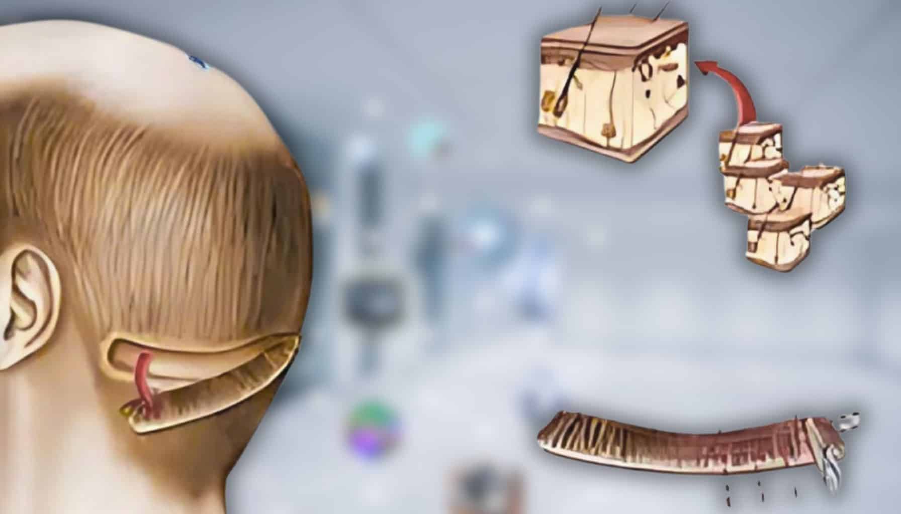 FUT hair transplant strip method showing scalp removal and graft placement