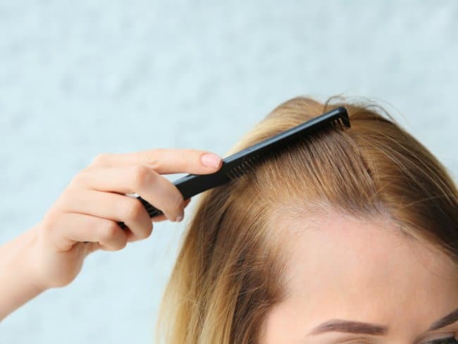 Minor traction alopecia, women's hair loss