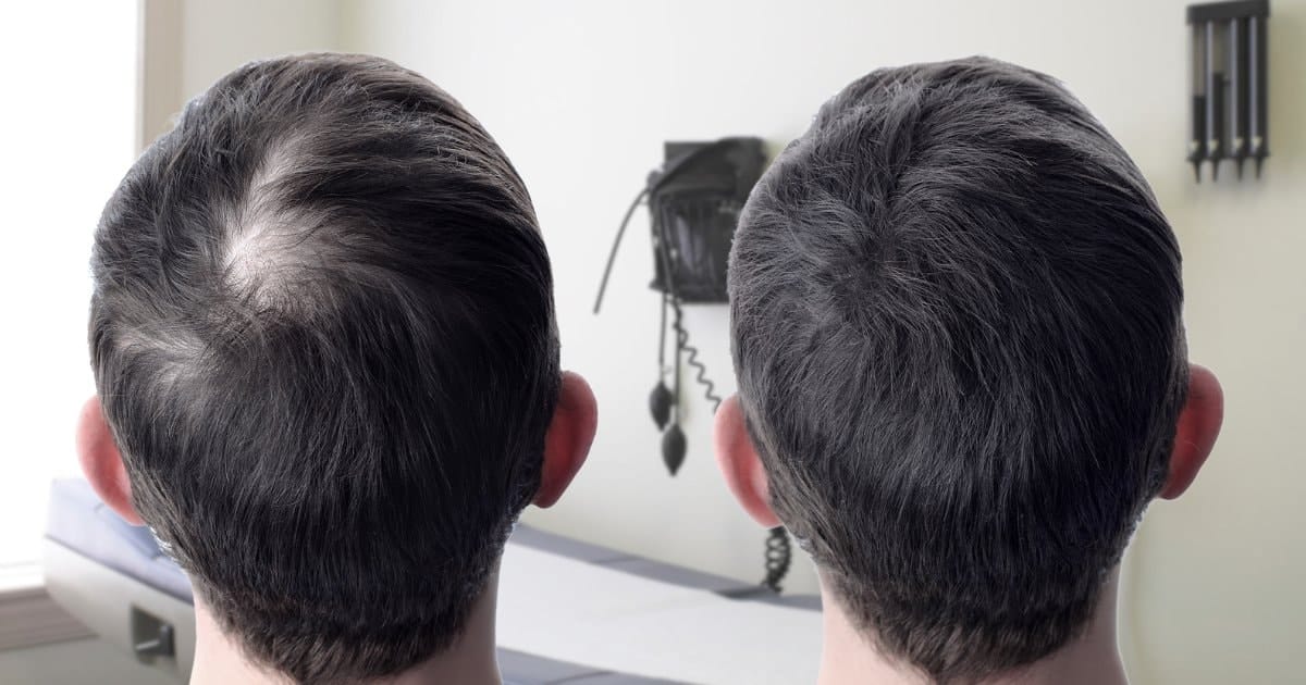 Image of a man 1 year post FUE hair transplant procedure, no robotic fue procedure