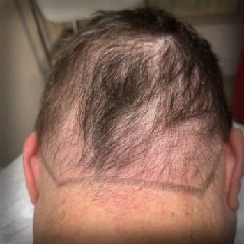 Before Image of a scalp micropigmentation