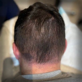 After Image of a scalp micropigmentation