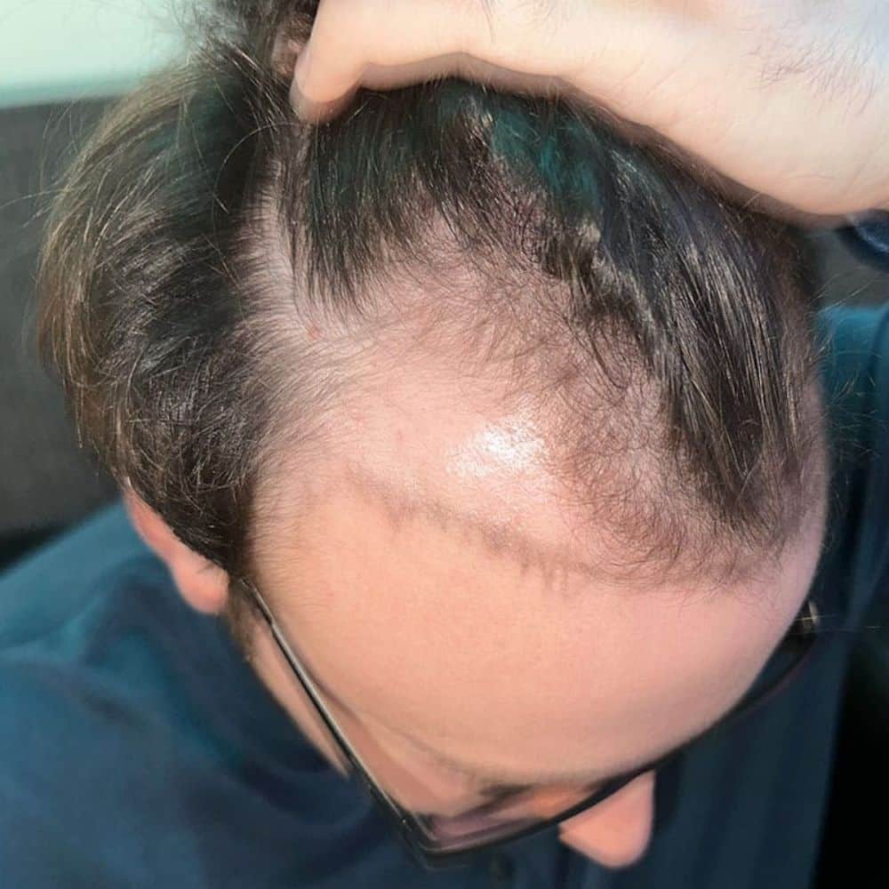 Before an fue hair transplant, male pattern baldness, under 30 years old