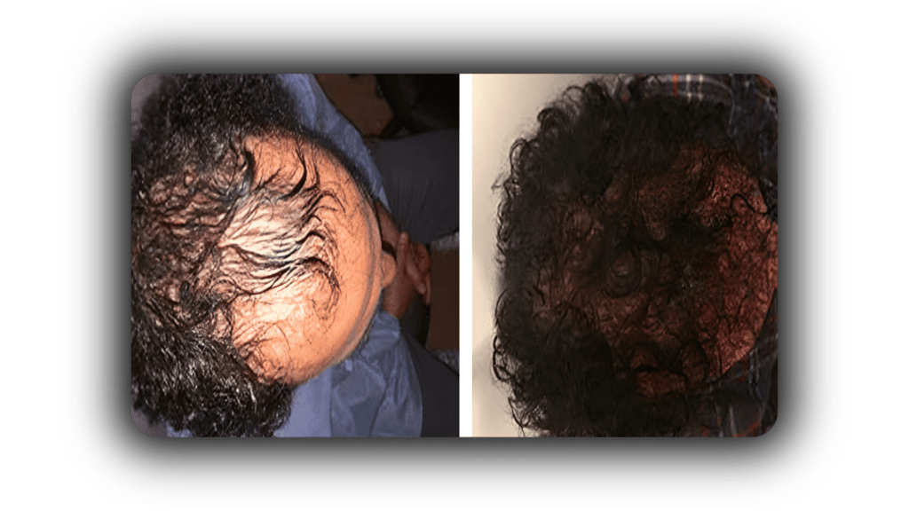 Before & After Shot of Hair Transplant, FUE Hair Transplant