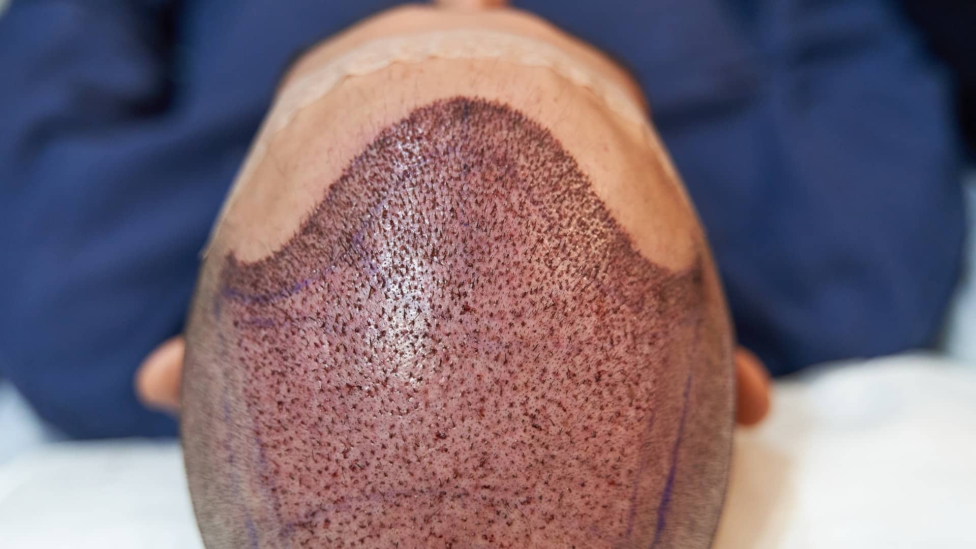 Post follicular unit transplantation Hair Transplant results