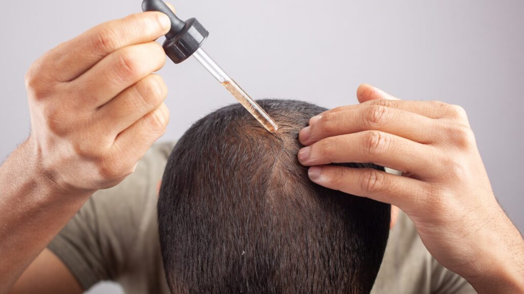 Traditional solutions with topical minoxidil as a hair loss treatment