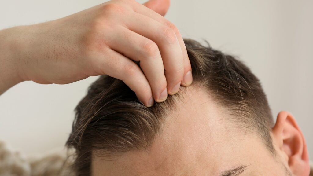 Image depicting Male Pattern Baldness, a form of thinning hair found in men