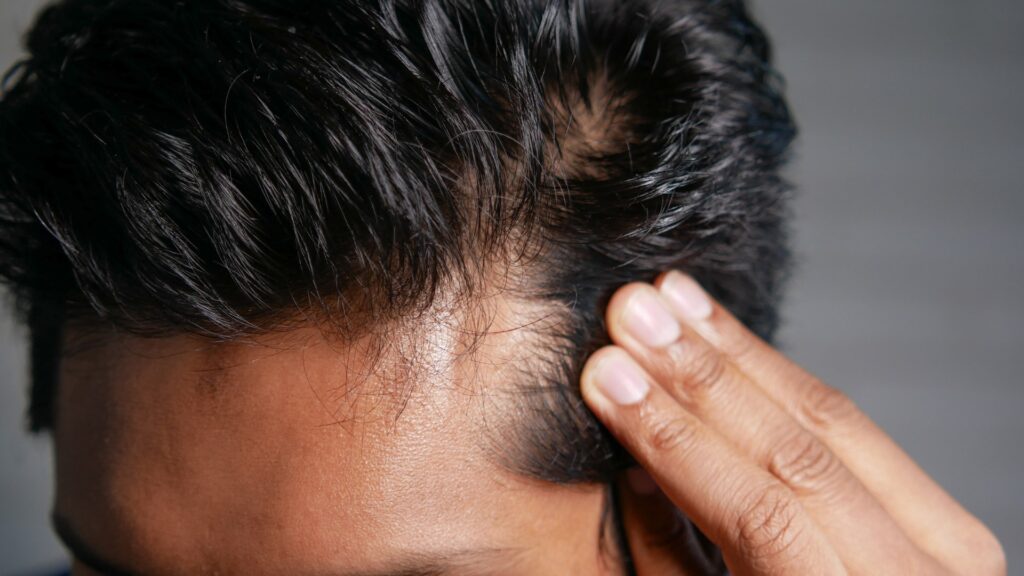 a man checking his hairline for potential hair loss that can be fixed with a hair transplant