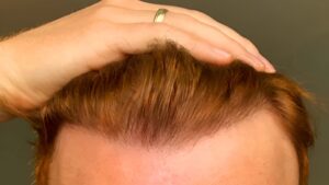 Can Redheads Get Hair Transplant Surgery?