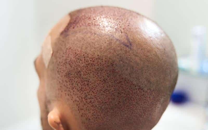 FUE When Are Grafts Secure After Your Hair Transplant