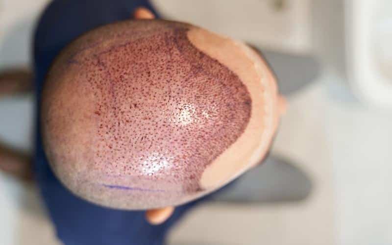 When Are Grafts Secure After Your Hair Transplant: Follicular unit extraction