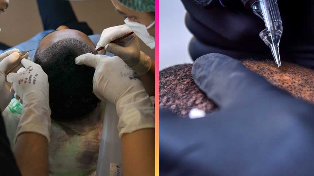 Hair Transplant and Scalp micropigmentation side by side images