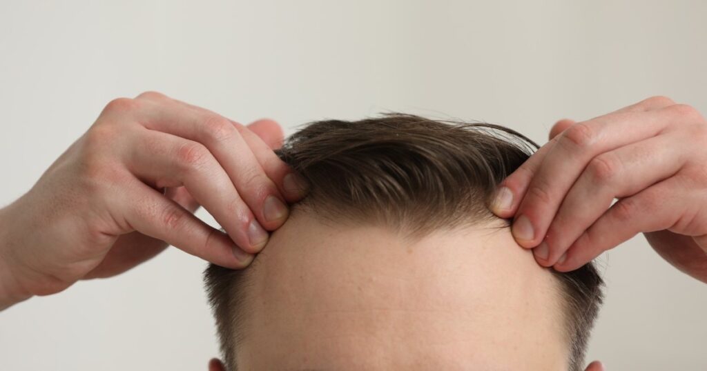 Principales Consejos sobre Cómo Detener la Pérdida de Cabello en la LÃnea Frontal