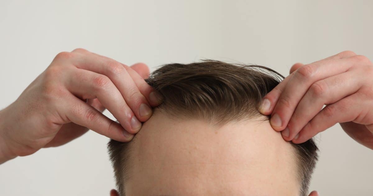 Principales Consejos sobre Cómo Detener la Pérdida de Cabello en la Línea Frontal