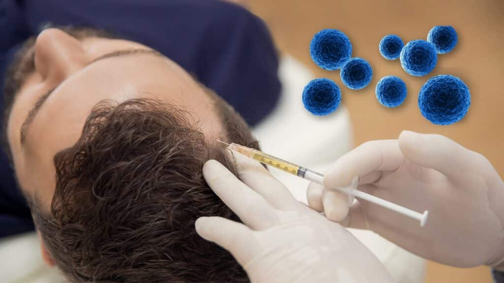 Stem Cells Use for Hair restoration