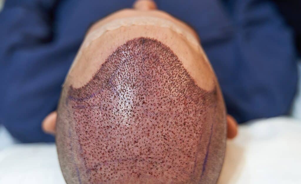 Image revealing a hair transplant being performed