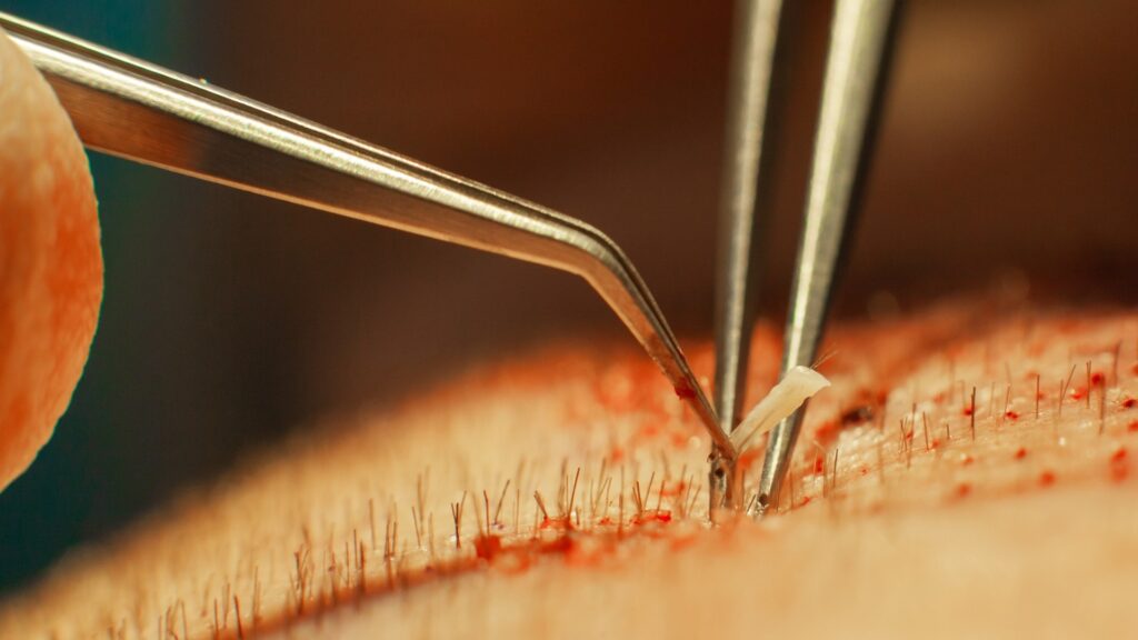 FUE Hair Transplantation in progress. Image reveals individual hair follicle with group of two hairs being transplanted into thinning area of the scalp