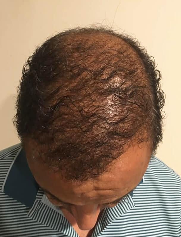 Minoxidil